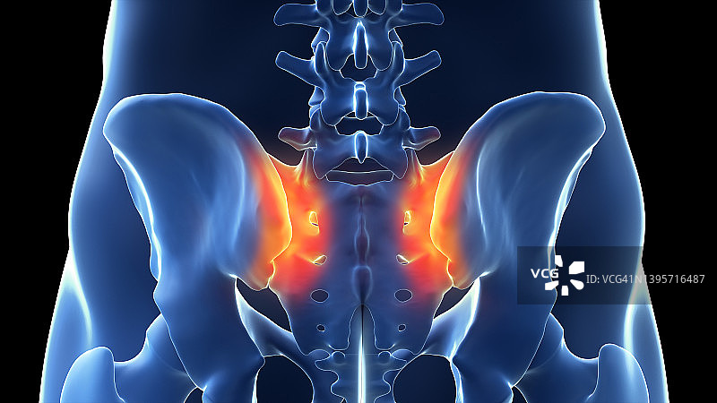 骶髂关节疼痛，图示图片素材