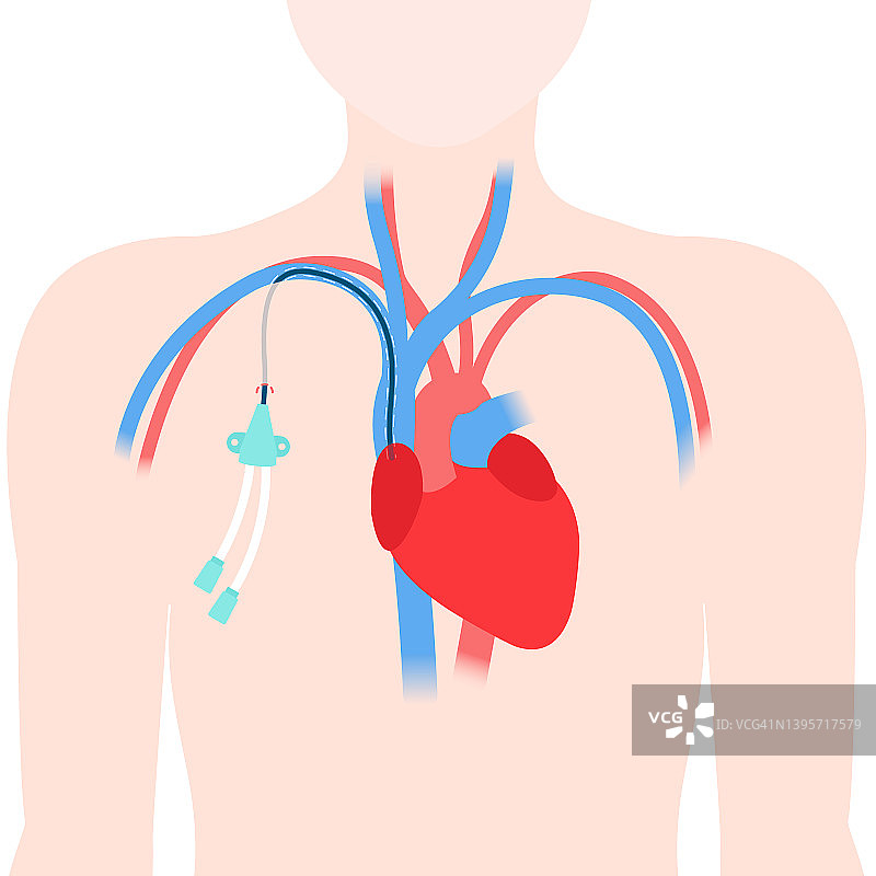 中心静脉导管，图示图片素材