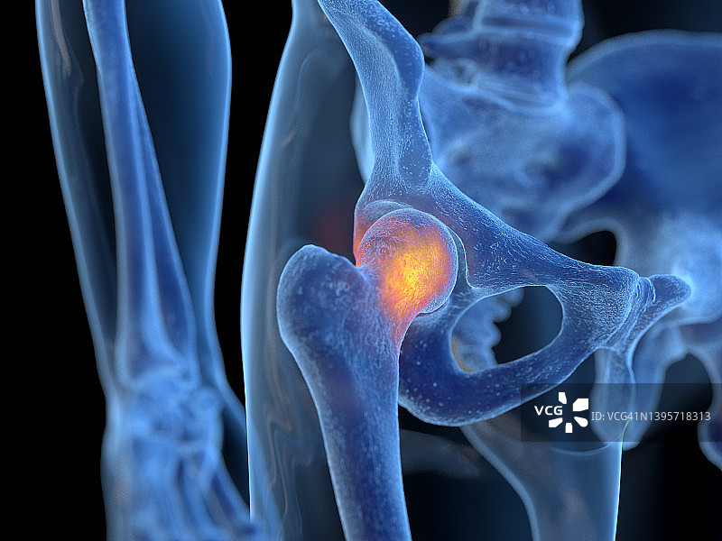 髋关节炎症插图图片素材
