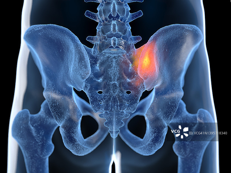 骶髂关节疼痛，图示图片素材