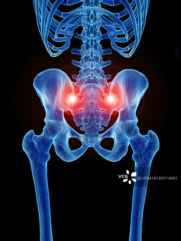 骶髂关节疼痛，图示图片素材