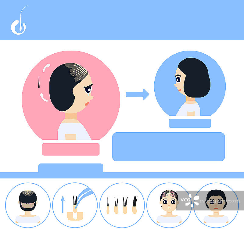 女性FUE毛发移植插图图片素材
