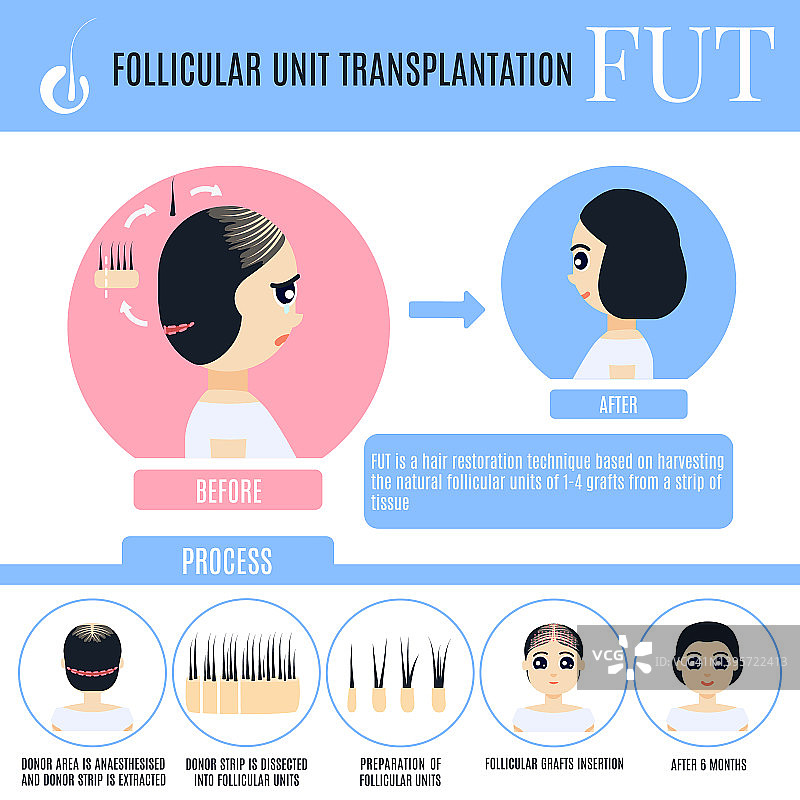女性FUT毛发移植图示图片素材