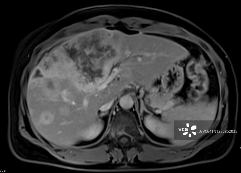 非肝硬化肝脏肿块的核磁共振评估图片素材