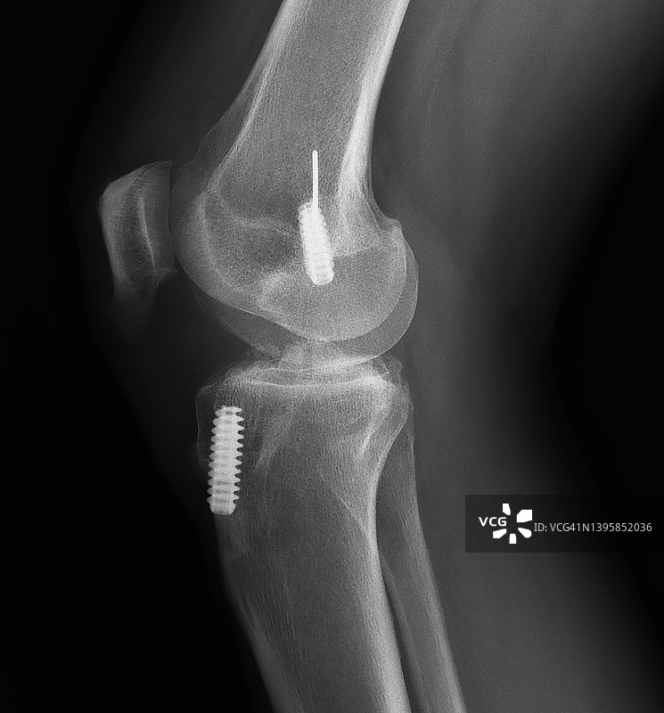 前交叉韧带重建的X光片评估图片素材