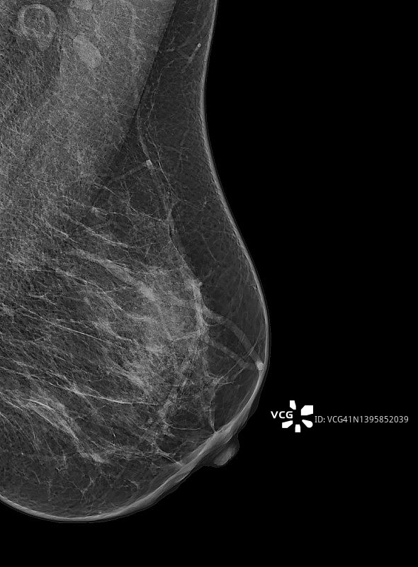 用于乳腺癌筛查的X射线数字乳腺钼靶或乳房X光照片图片素材