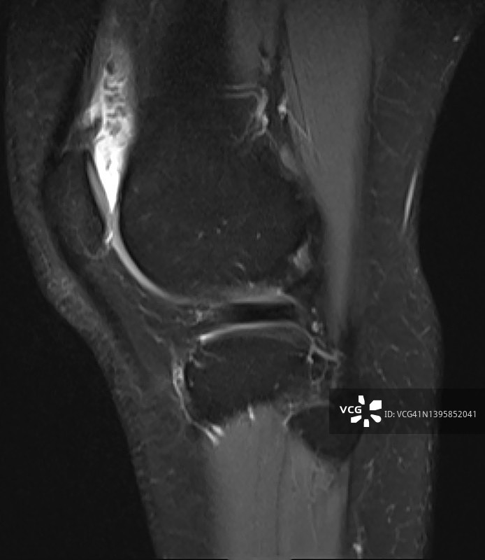 色素沉着绒毛结节性滑膜炎-膝盖MRI图，矢状位T2压脂像图片素材