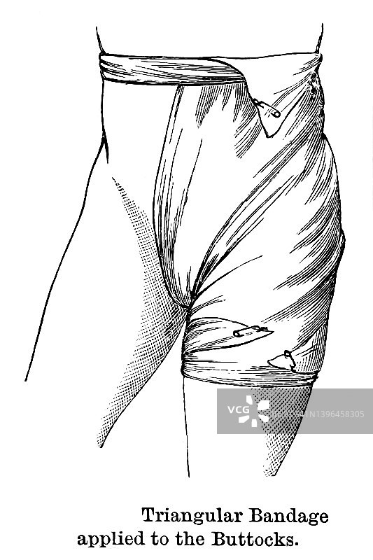 老式雕刻插图：应用于臀部的三角绷带图片素材