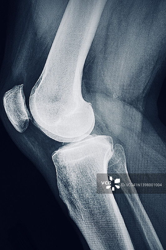 人体膝关节图片素材