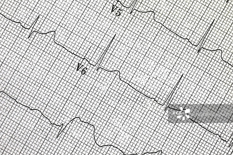健康的心电图（EKG）图片素材