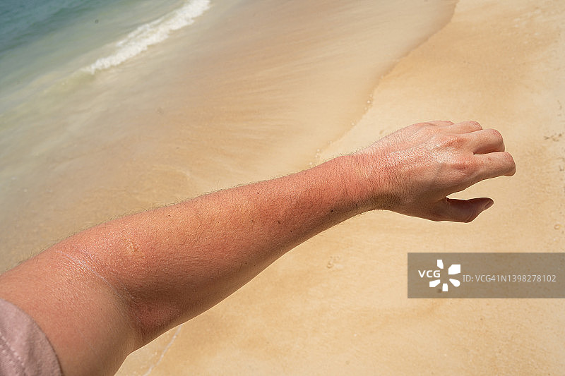 在海滩上晒伤的男人的手图片素材