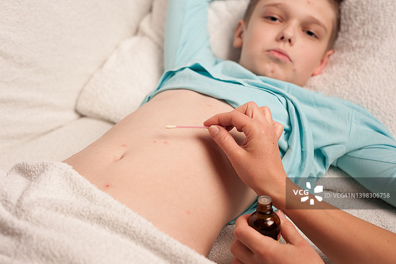 水痘的治疗图片素材