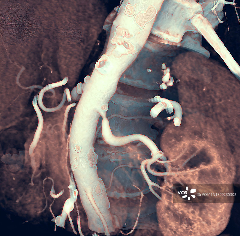 左肾动脉狭窄图片素材