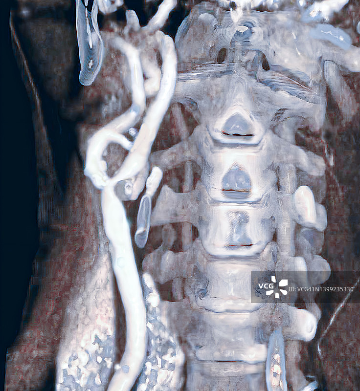 颈动脉狭窄3D扫描图片素材