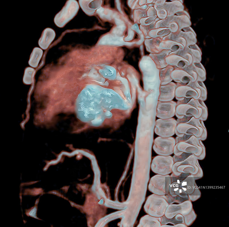主动脉缩窄图片素材