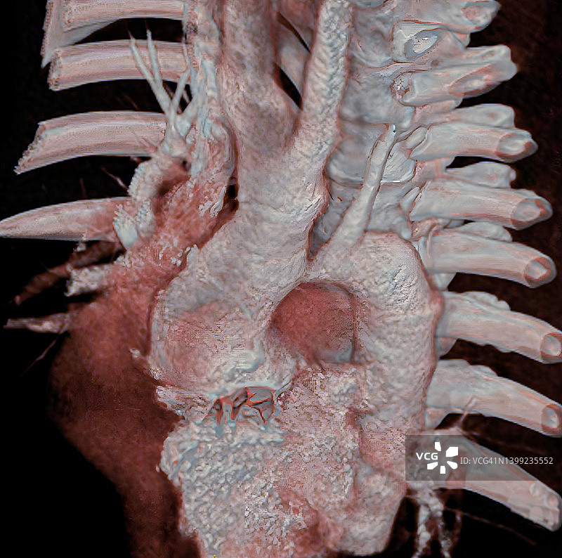 主动脉缩窄图片素材