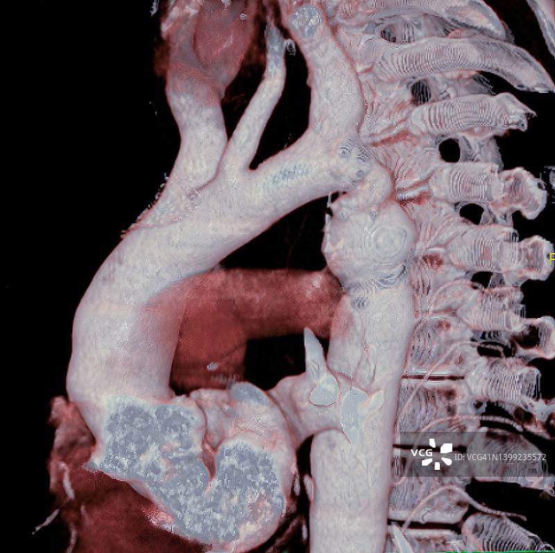 主动脉缩窄图片素材