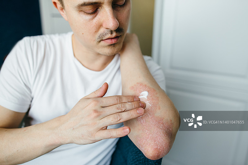 男人使用药膏治疗湿疹、牛皮癣等皮肤病图片素材