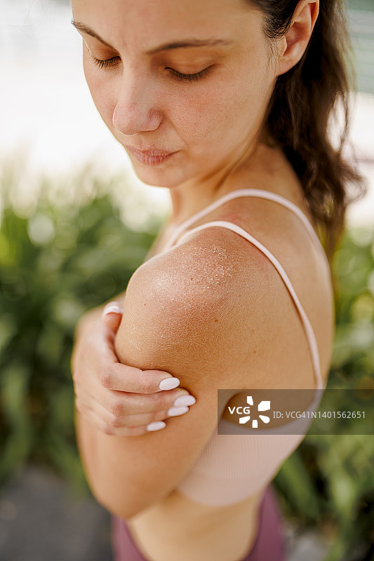 女性背部晒伤图片素材