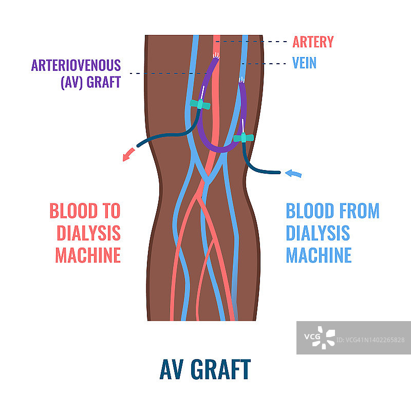 透析分流移植导管插图图片素材