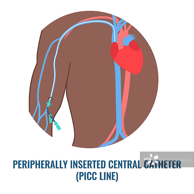 PICC静脉输液装置，图示图片素材