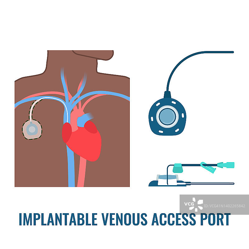 静脉通路端口插图图片素材