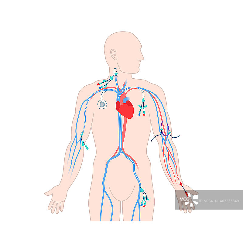 中心静脉导管，图示图片素材