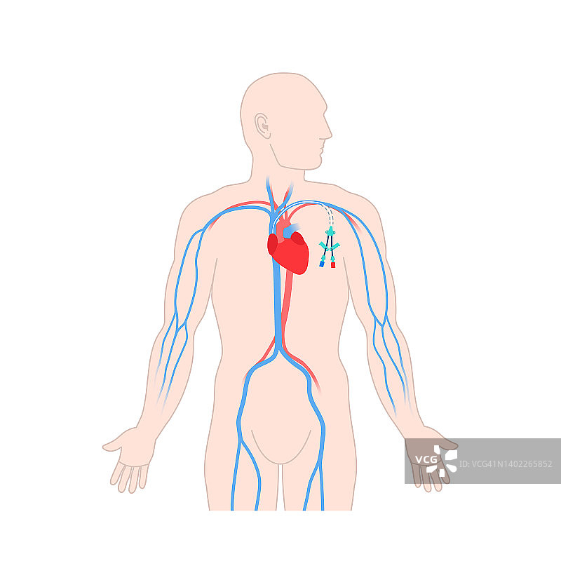 中心静脉导管，图示图片素材