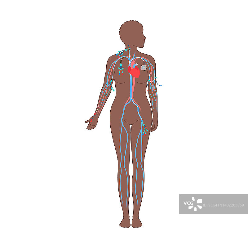中心静脉导管，图示图片素材
