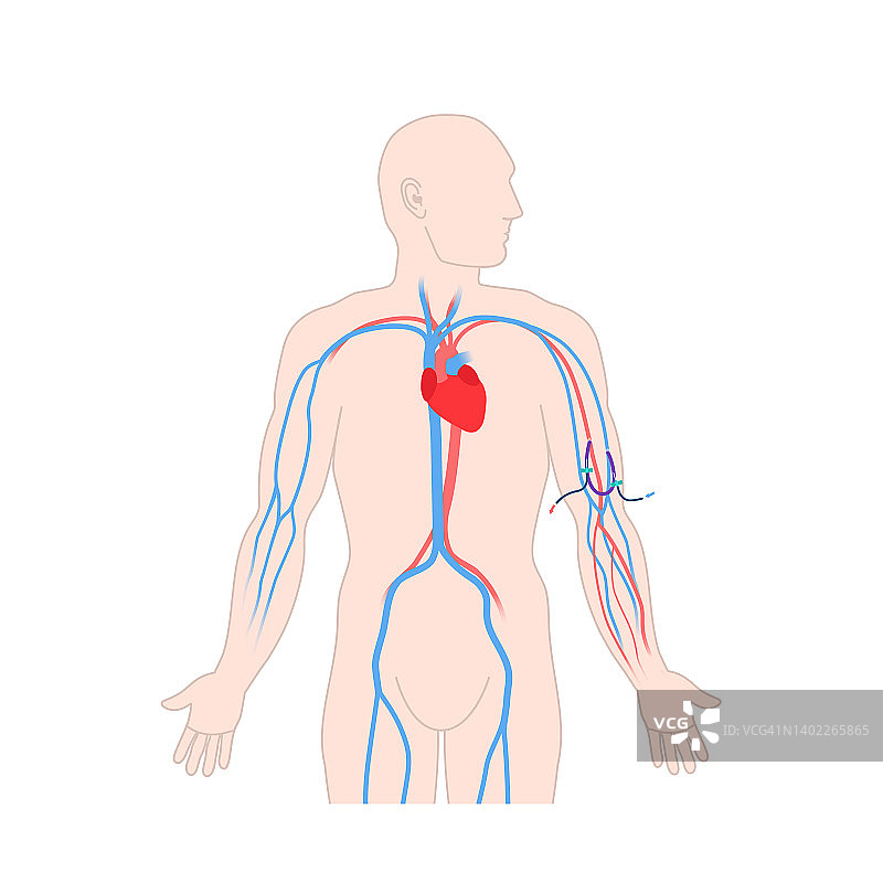 透析分流移植导管插图图片素材