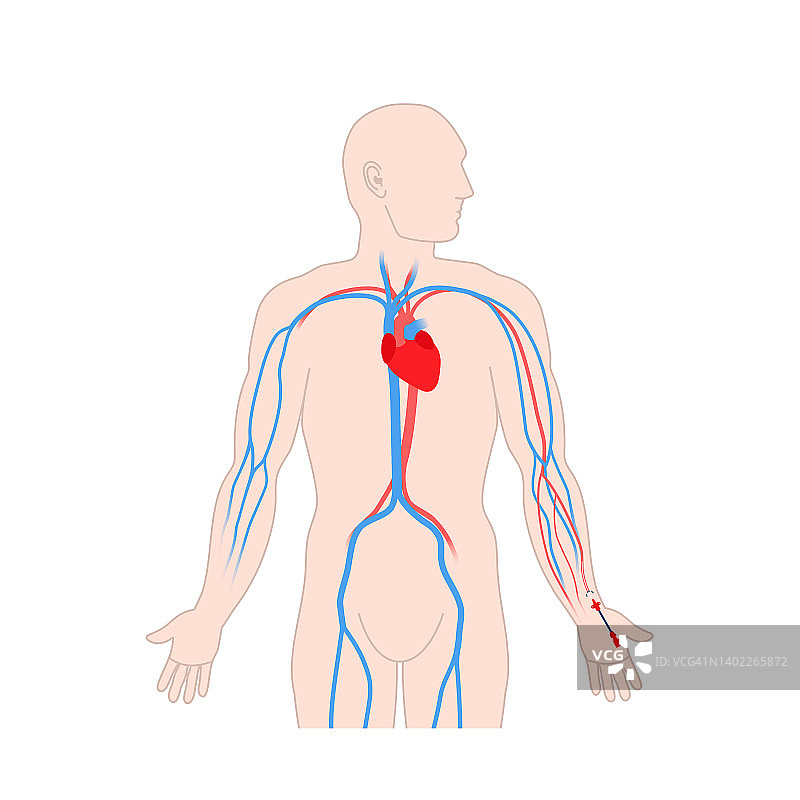 动脉导管插图图片素材