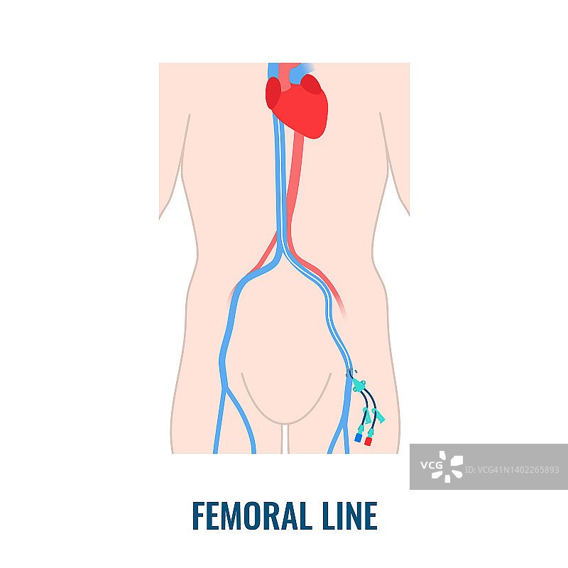 股静脉中心静脉导管插管图示图片素材