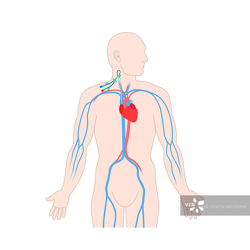 中心静脉导管，图示图片素材