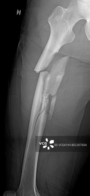 股骨粉碎性骨折X光片图片素材