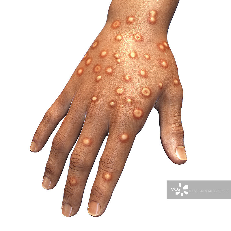 猴痘感染插图图片素材