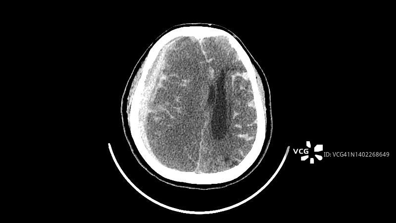 出血性中风CT扫描图片素材