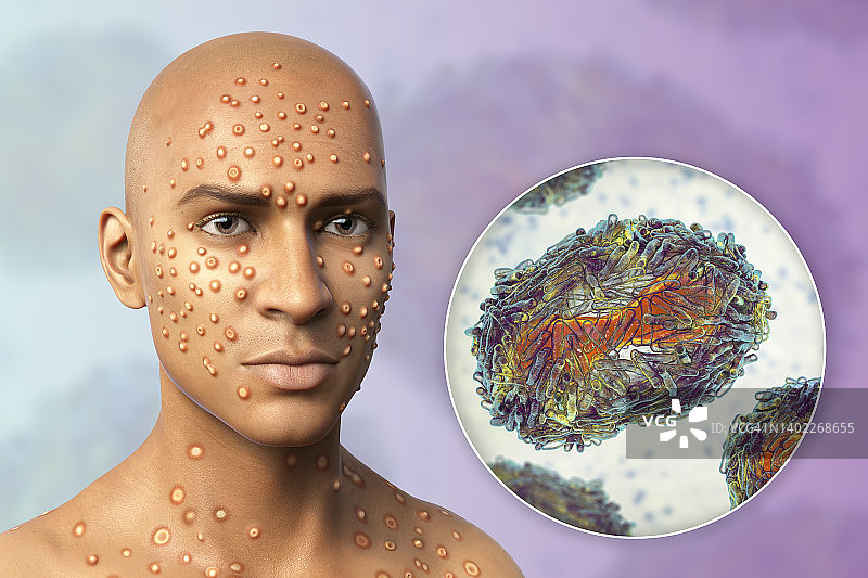 猴痘感染插图图片素材