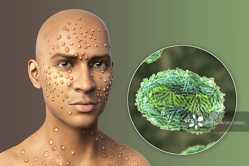 猴痘感染插图图片素材