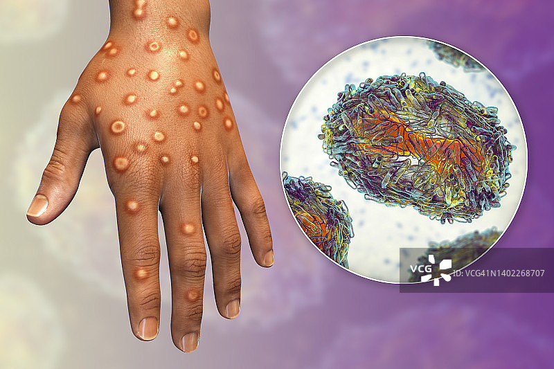 猴痘感染插图图片素材