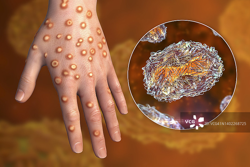 猴痘感染插图图片素材