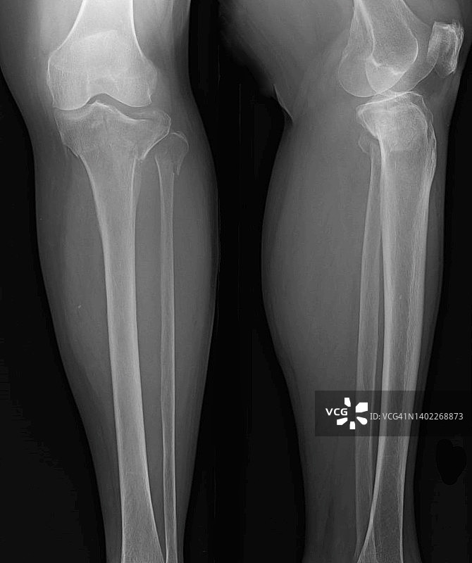 胫骨平台骨折X光片图片素材