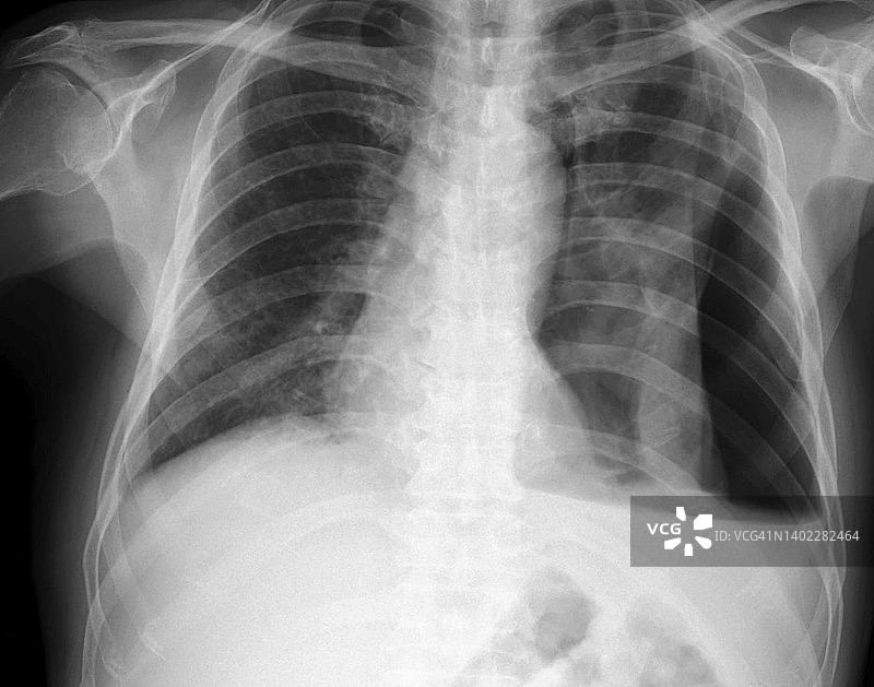 气液胸腔积气X光片图片素材