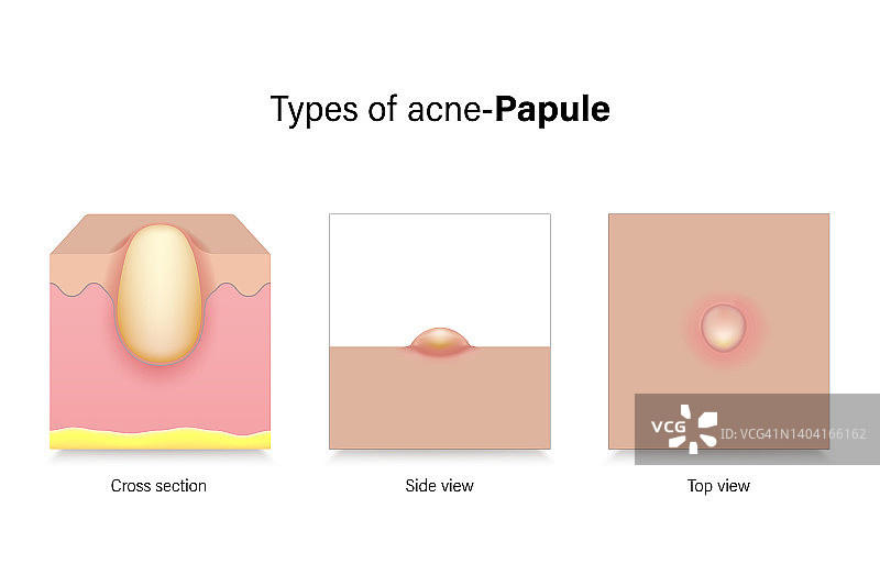 痤疮的类型。皮肤问题。丘疹横截面、侧视图和顶视图。用于美容和医疗广告的矢量素材。图片素材