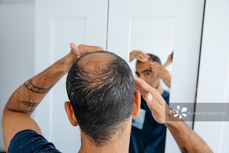 光头男人照镜子，看着头顶的秃发和脱发图片素材