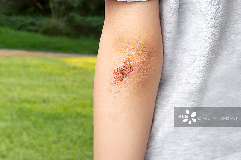 胳膊肘受伤的男孩图片素材