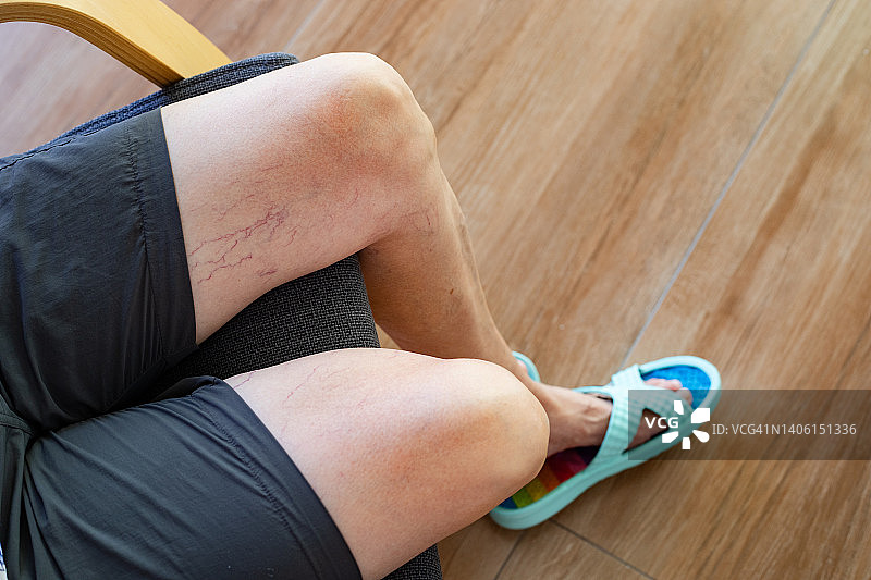 患有静脉曲张和蜘蛛静脉的女人腿图片素材