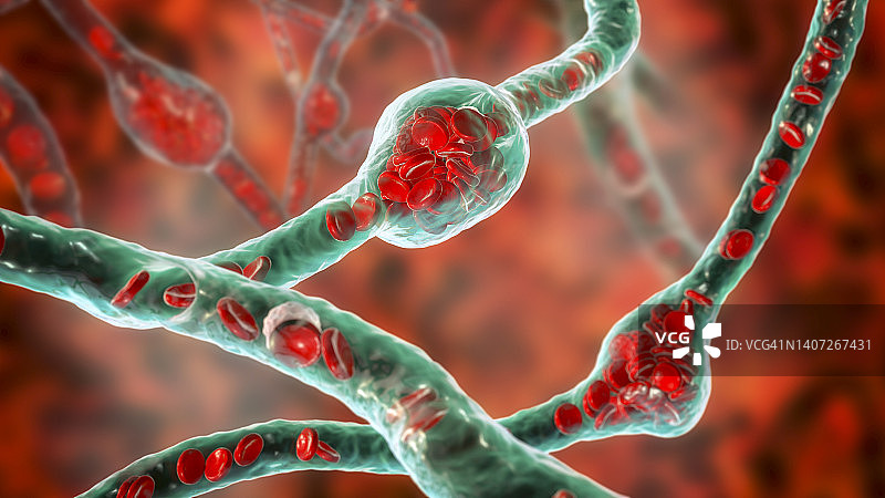 微动脉瘤插图图片素材