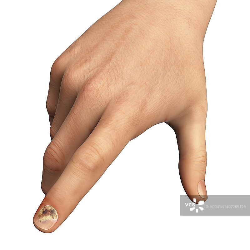 甲癣插图图片素材