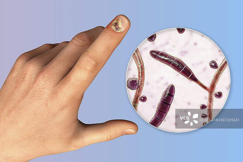 甲癣插图图片素材