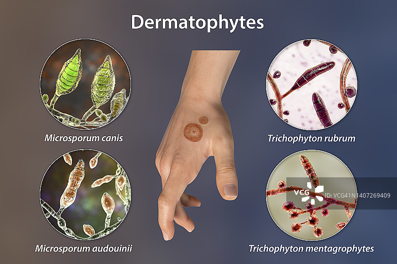 癣，图示图片素材
